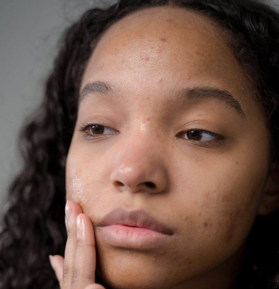 Why am I getting Dark Spots on my face? — GMARO Magazine
